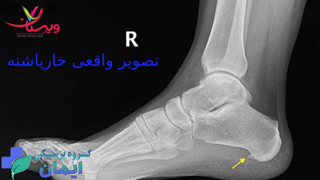 خارپاشنه عکس رادیولوژی مربوط به خارپاشنه پای راست