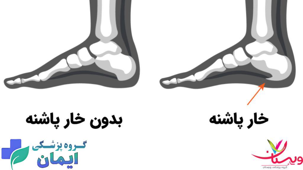 عکس خارپاشنه تصویری از خارپاشنه و مقایسه با پای سالم