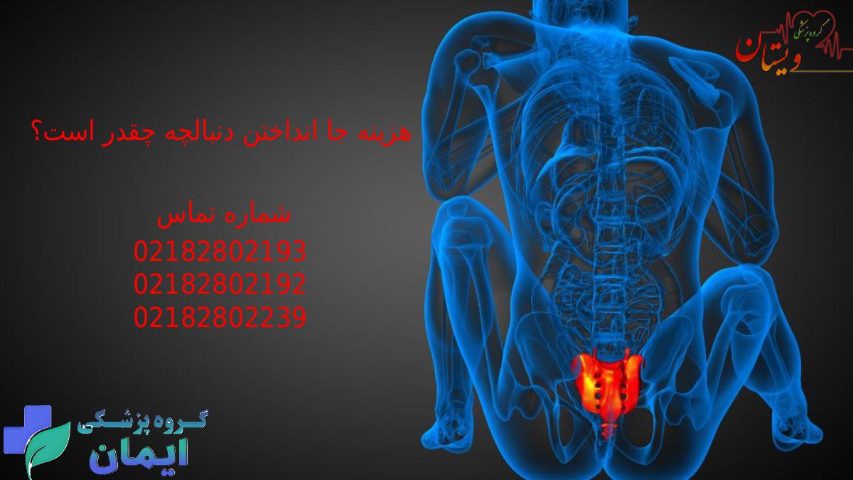 هزینه جا انداختن دنبالچه در سال 1404 چقدر است؟