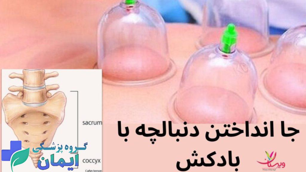 جا انداختن دنبالچه با بادکش تصاویر از بادکش هایی که روی دنبالچه قرار داده شده تا جاانداخته شود.