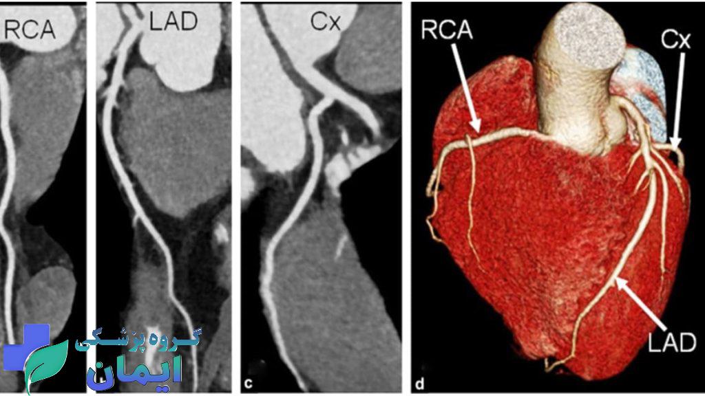 تفسیر سی تی انژیو قلب اصطلاحات موجود در جواب سی تی انژیو قلب